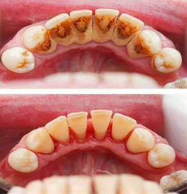 scaling dan polishing karang gigi