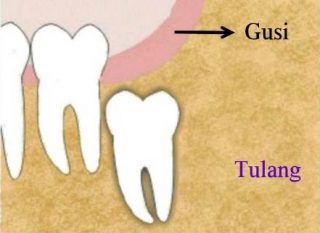 Gambar impaksi dalam tulang menyeluruh