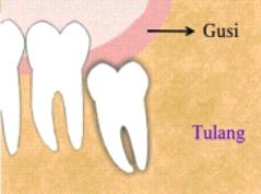 gambar gigi impaksi dalam tulang sebagian